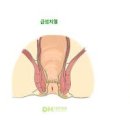 항문질환 종류 증상 그리고 왜 여름철에 자주 발생하는지에 대한 이유 이미지