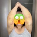 멍 | 인천,부천 팔뚝 무한람스 약 2달차 후기 / 멍, 붓기, 통증