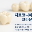 서울e-고은치과의원 | 노량진 치과 어금니 신경치료 비용 후기 (Feat. 술, 지르코니아)