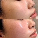 문수지 | 대구북구피부관리, 색소 관리 10회 후 흑자 100% 제거된 실제 사례 공개