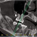 닥터유치과의원 | 보정동사랑니 발치 진짜 안 아플까? 통증 마취 비용까지 알려드립니다