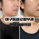 미소가인피부과의원 | 대구동성로피부과 인모드 풀페이스 연세바비의원 솔직후기 할인정보