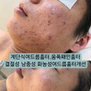 화서1동 | 수원피부관리 플레브에스테틱 여드름흉터 압출 잘하는 피부관리실추천