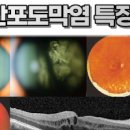 포도막염 증세 및 , 홍채염 (시야흐림, 눈부심현상, 안구통증, 오른쪽 왼쪽 눈통증) 이미지