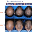 (주)베라테크 | '바르는 대신 먹는 미녹시딜', 베라더믹스(MANE)가 선보이는 경구 탈모 치료제의 기대감