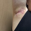 (주)다한디자인 | 안양 겨드랑이땀냄새, 다한증 미라드라이 후기 가격 절개수술 없이 영구적 효과! 사계절 뽀송 후기!