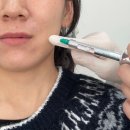 6전6회 | 당황스러울 정도로 효과 좋았던 콜라겐 주사, 6회차 내돈내산 후기(스컬트라 쥬베룩볼륨)