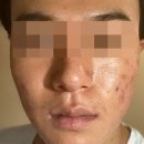 나을한의원 | 지루성피부염 한의원 치료 관리 후기