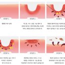 [여드름 흉터치료] 압구정 신사동 피부과 한의원 상담&amp;견적 비교