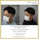 일러스라인 | 탈모치료로 두피관리샵 일러스라인에서 자연스럽게 구렛나루 시술!