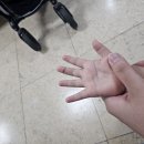 하나병원 | 부산 돌아기 화상 / 유아 화상- 비용, 베스티안 vs 하나병원 후기 비용