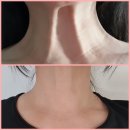 진앤모 | 40대 중반 목주름보톡스 2주 후기~ 다들 젊어보인대요