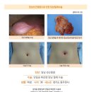 담낭제거수술후. 원장님이 너무 친절하게 설명도 잘해주시고 복강경으로 흉터도 남지 않게 구멍도 한 개 뚫어서 깔끔하게 하셨습니다... 이미지