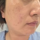 터치앤래쉬 | 진주 스킨플래닝 추천, 르노아 왁싱앤래쉬에서 진주 최초 엑시드닝 관리 받아본 솔직후기