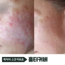 정우빌딩3차 | 흉터커버 3차 스킨 카모 진행후기