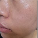 강남미의원 | 강남역미의원 아쿠아필 가격 통증 후기!