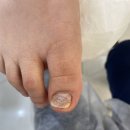 몽타운 | 당산 네일, 영등포 내성발톱 교정 후기 &#34;네일몽 레푸스 당산점&#34;