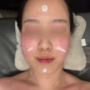천안문제성피부 청당동에스테틱 뉴에스테틱 작은 얼굴 반쪽 윤곽 후기