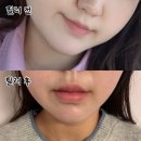 필러 스튜디오 | 압구정피부과 자연스러운 입술필러 쥬브겔 추천 후기 통증 전후비교