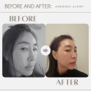 한결한의원 | 서면한의원 온다리프팅 LDM 후기｜이중턱 리프팅 효과와 관리주기