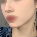 의정부빔스테틱의원 | 의정부 리프팅 잘하는곳 예비 신부 리프팅 후기