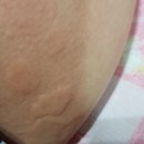 님들 이거 땀띠인가요?사진주의 이미지