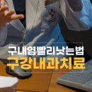 구내염빨리낫는법 구강내과치과에서 원인을 제대로 알고 나면