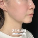 창원1 | 창원 상남동 피부과 온다리프팅 1회차 후기/효과/통증