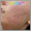 세종피부과추천 리쥬란 받기전에 이것만 기억하세요.