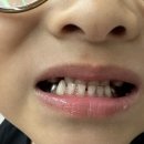 백승학 | 유아 반대교합 치아교정 서울대치과병원 교정후기 및 교정비용 (프랑켈교정장치, 가철식유지장치)