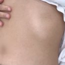 장안토탈케어 | 수원피부관리 편평사마귀 제거 후기 | 스무살에머물다 수원스타필드점