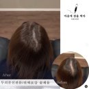 마음에점을찍다두피SMP 이미지