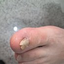 악성 발톱무좀 치료 및 사후 관리 상담 만족 후기 레푸스 용산역점