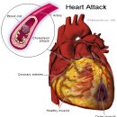 심근경색 [心筋梗塞, myocardial infarction] 이미지