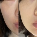 순백피부과 | [리뷰] 영등포피부과 스킨보톡스 (순백주사, 더모톡스) 후기 - 눈가주름,모공개선