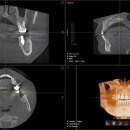 무절개 임플란트와 발치즉시식립(상악동거상및치조골이식) 이미지