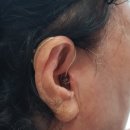 스타키보청기춘천난청센터 | [대구보청기] 중이염과 고심도 난청에도 도움이 된 스타키 제네시스AI 착용 후기