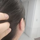[위례] 귀 켈로이드 수술 및 메리츠 실비 청구 후기