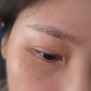 라인1차 | ♡아이라인 문신 타투 제거 1차 2주 후기! 내돈내산♡