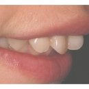 [치아성형] 삐뚤어진 돌출치아 치아성형으로 예뻐지기 이미지