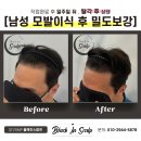 대구두피문신 모발이식 후 부족한 밀도보강 (남성고객님)