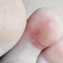 유앤영피부과의원 | 하다하다 이제 한포진까지!