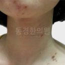 혈소판 수치 높음 낮음 정상수치 증가 원인 이미지