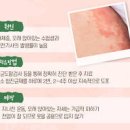 사타구니 습진 백선 염증 가려움 완선 원인 증상 치료 이미지