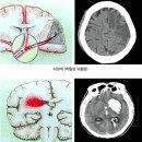 사망률 1위 뇌혈관 질환의 危嚴~! 이미지