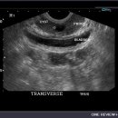 Prostatic utricle cyst 이미지