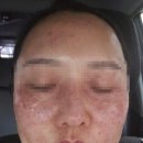 1091 | [기록] 잡티제거의 끝판왕! 루비레이저 1091샷 내돈내산