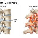 광명 정형외과 고개 돌릴 때 목뒤 뻐근함과 찌릿한 통증 나타나는 이유
