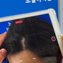 노블라인의원 | 한국에서 제일잘하는 모발이식 - 압구정 노블라인의원 남자 m자비절개 모발이식 실제후기-협찬x댓가성x...