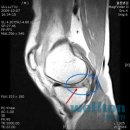 [무릎연골파열] 반월상 연골 파열 관절경 수술로 치료하세요! 이미지